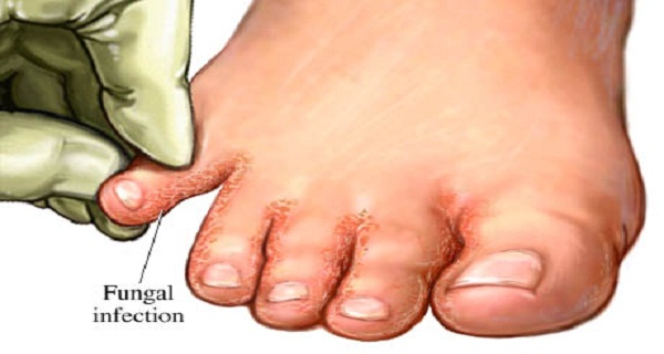 Say Goodbye to Fungal Infections Soak Your Feet In...