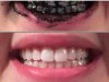 The Little-Known Inexpensive Teeth Whitener and Detox Agent teeth