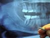 Shocking connection: 97% of all terminal cancer patients previously had a root canal procedure… rootcanal